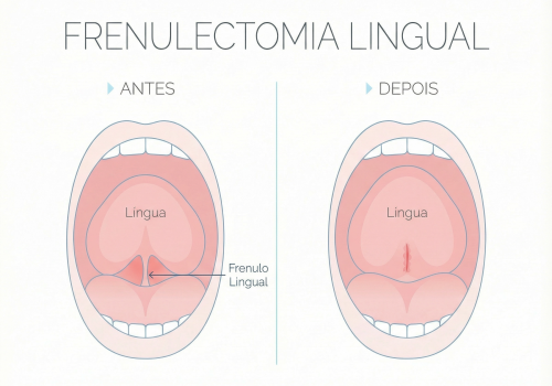 09_frenulectomia_lingual_v2